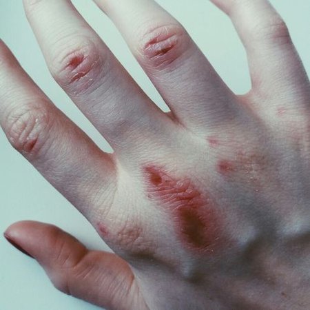 Bruises and Injuries - Knuckles