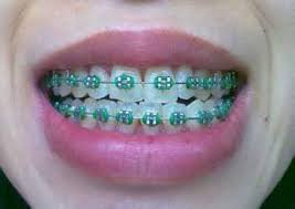 mint green braces