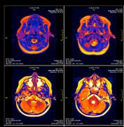 epilepsy brain scan - Google Search