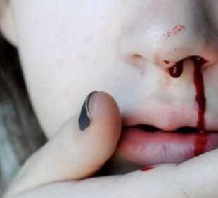 bleeding nose