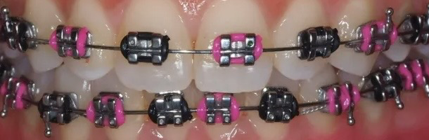 pink and black braces