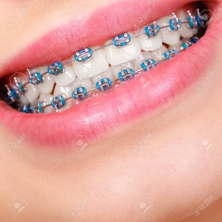 Blue braces