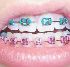 pink and blue braces - Google Search