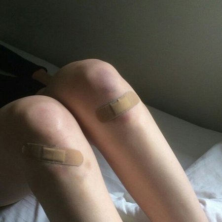 Bruises and Injuries - Leg