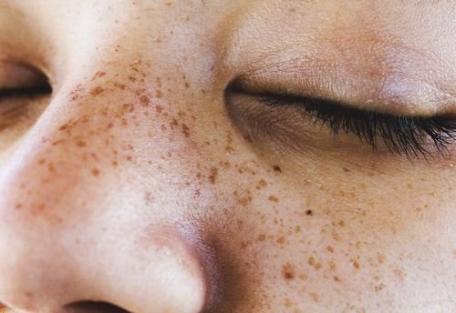 aesthetic freckles pinterest - Pesquisa Google