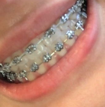 silver braces
