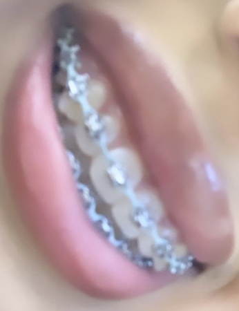 light blue braces