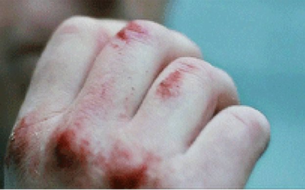 bloody knuckles