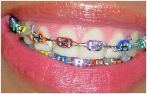 colorful braces