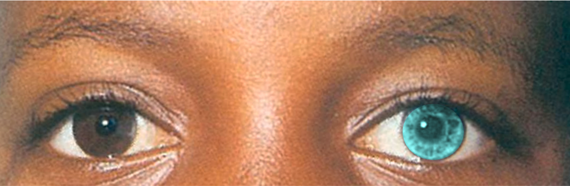 Dark Skin Mint Eye Heterochromia