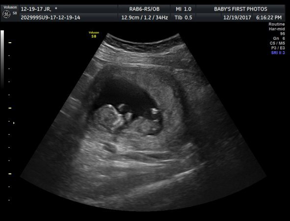 Help our baby #3. Boy or girl? 12 week ultrasound - BabyCenter