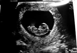 10 weeks pregnant ultrasound - Google Search
