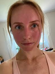very red face - Google Search