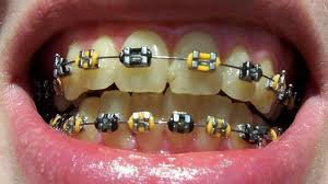 yellow braces on teeth - Google Search
